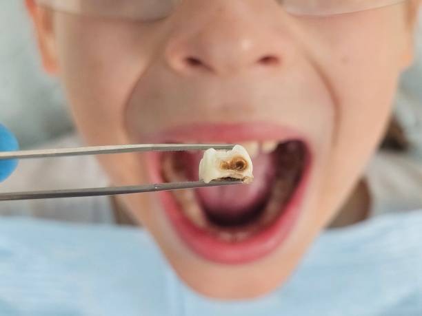 Best Emergency Treatment for Toothache in Manti, UT